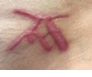 One DOS slave, whose initials just happened to be A-M, told Frank Report that when she initially saw her brand she thought it was her own initials that Dr. Danielle Porter branded upon her. Then when she read Frank Report, she realized that the initials were not hers, but Allison Mack's. She was horrified at the thought that she had both Keith Raniere's and Allison Mack's initials scarred upon her pubic area for life. She was not told in advance that this was going to happen and she was not told that Raniere was the secret head of DOS. But Allison Mack knew - and deliberately withheld this information.