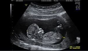 abortion 1