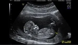 abortion 1