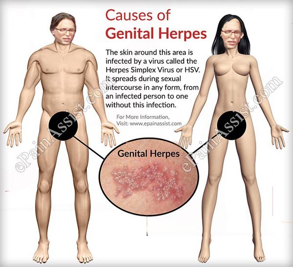 If he had it, Keith Raniere would not have been timid about sharing his herpes with his harem.