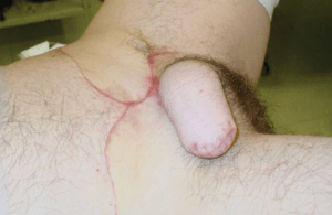 phalloplasty bottom surgery trans