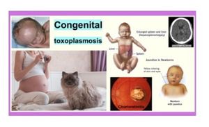 Toxoplasmosis