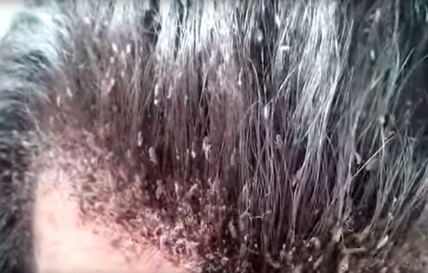 Keith Raniere Has Head Lice & Had Hair Shorn Off