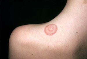 Ringworm on Shoulder