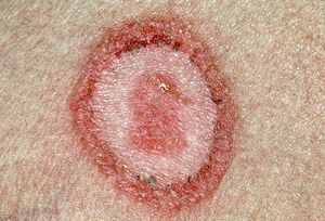 Close-Up Photo of Ringworm
