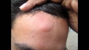 Keith got a boo-boo like this while he was recently in the SHU