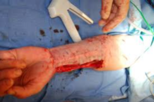 phalloplasty arm surgery trans